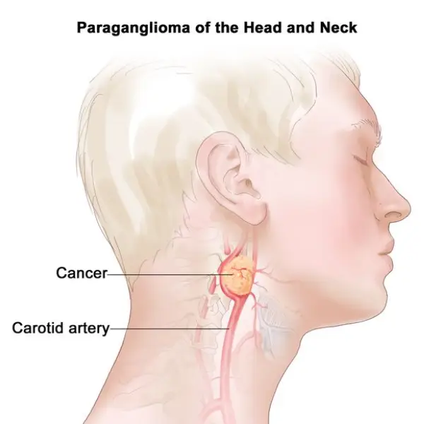 جراحی تومور کاروتید