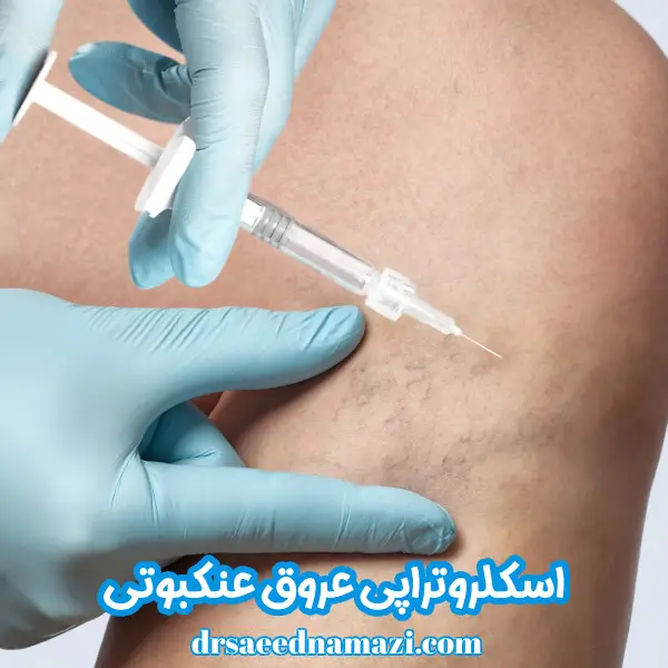 اسکلروتراپی عروق عنکبوتی